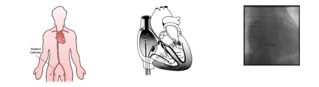 SBCOR – Arritmia Cardíaca e Eletrofisiologia